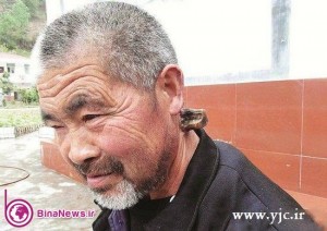 مردی که در گردنش شاخ دارد! +عکس